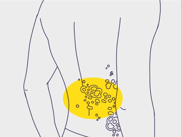 대상포진 전염성 허벅지 허리 팔 대상포진 증상 정리