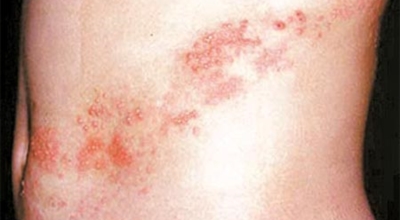 대상포진이미지