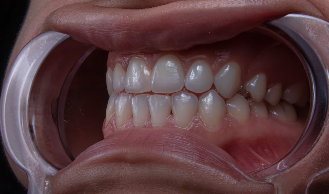 Periodontitis.
