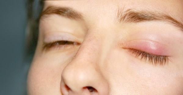 다래끼 원인 종류 빨리낫는법 눈다래끼 초기증상 치료 전염 찜질