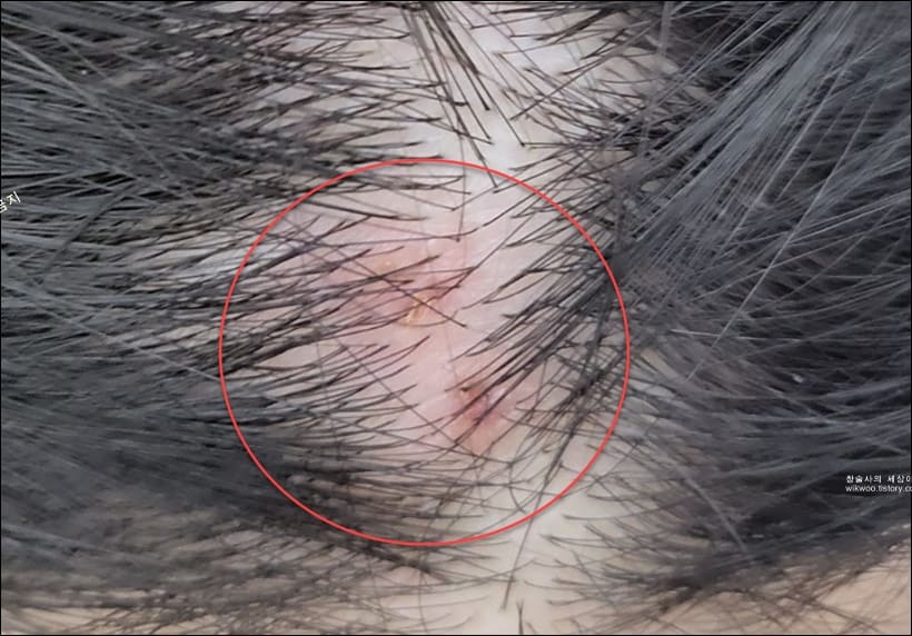 머리 대상포진 초기증상
