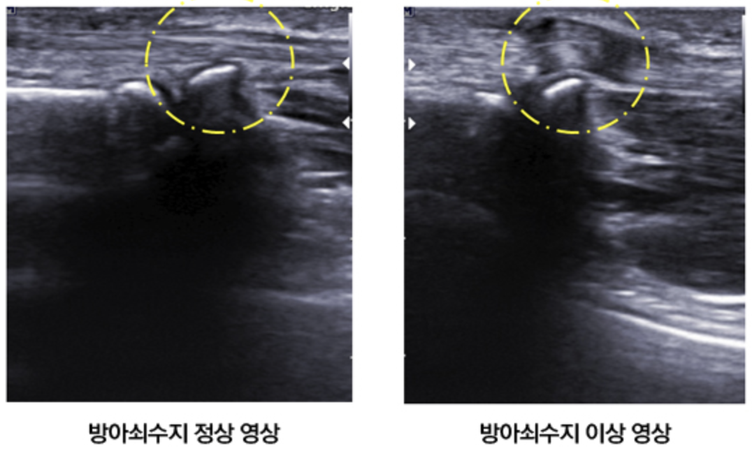 방아쇠수지초음파검사-트리거핑거초음파검사