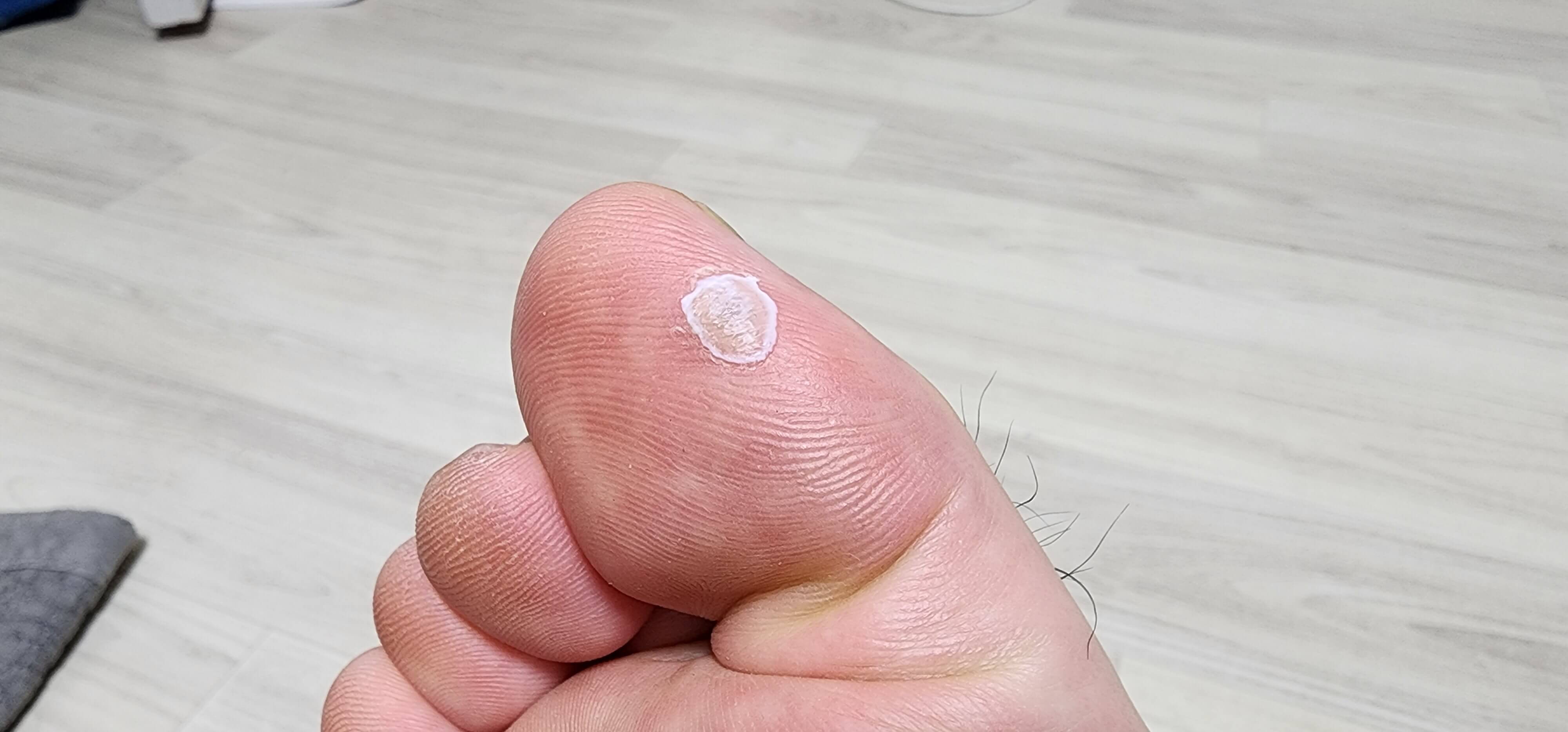 그린티눈액 바른후의 모습