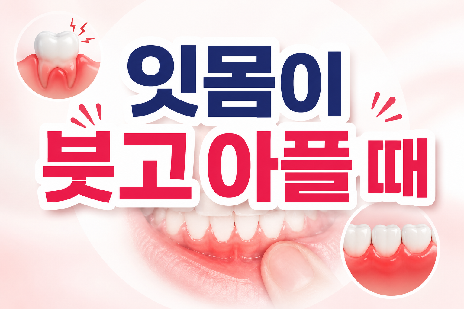 잇몸이 븟고 아플 때