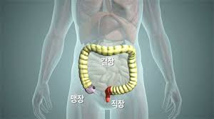 맹장의 위치과 증상