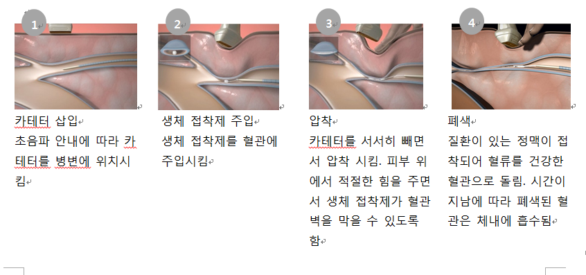 베나실(VenaSeal) 개요