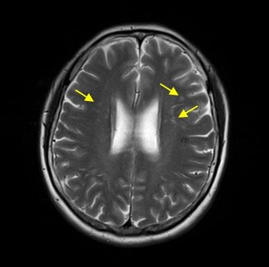 무증상-뇌경색-진단-특징-위험성-보험금-지급-질병코드