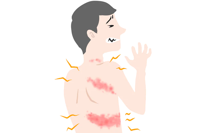 대상포진 초기증상