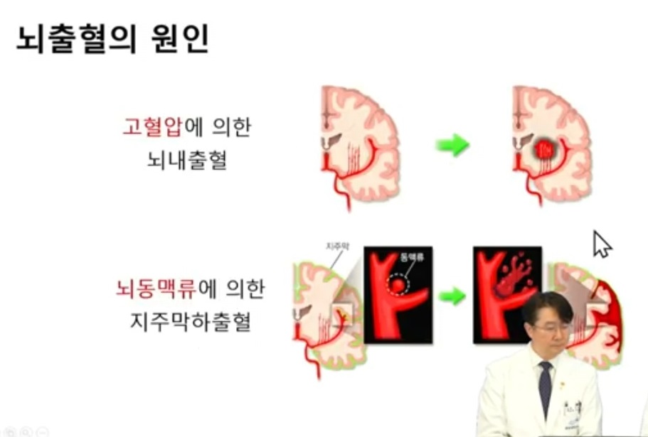 뇌출혈원인