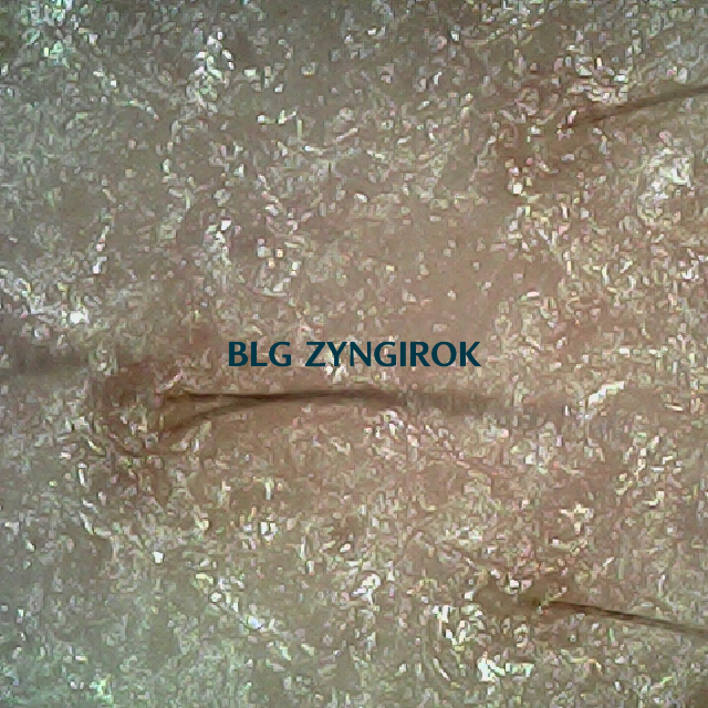 탈모 극복 프로젝트 - 오른쪽 M자 부위 두피 모습이다.