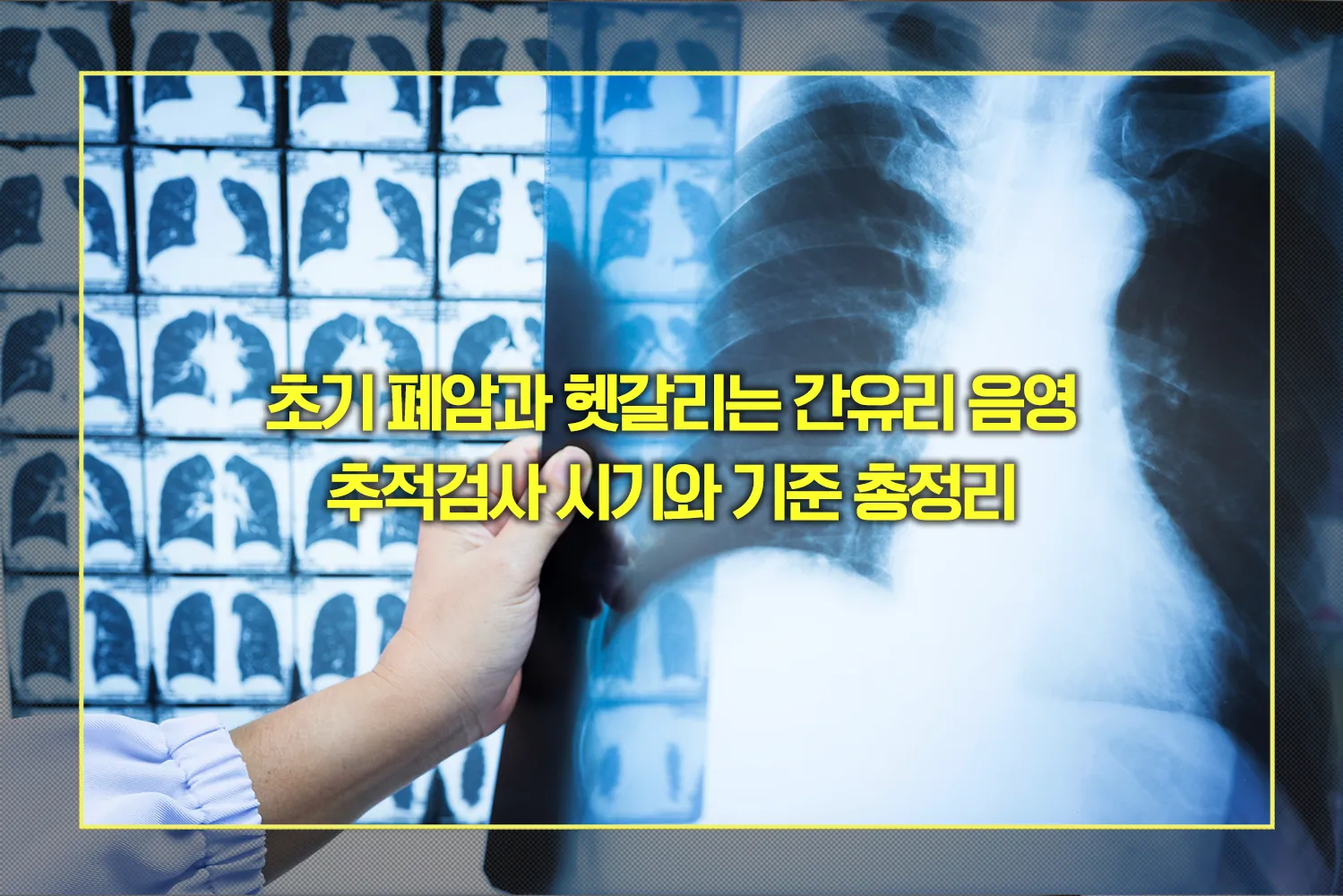 간유리 음영 추적검사 시기와 기준