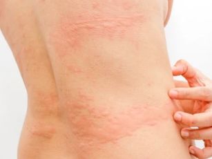 피부 발진 종류