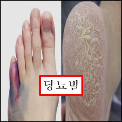 당뇨발 이미지
