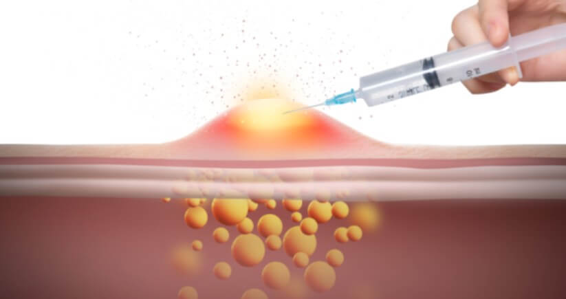 스테로이드 주사 투여