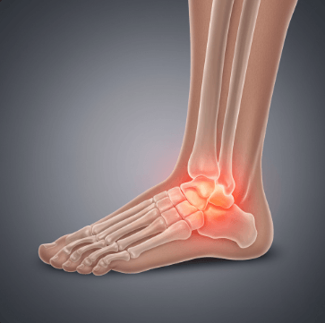 복숭아뼈 통증 완화하는 방법3