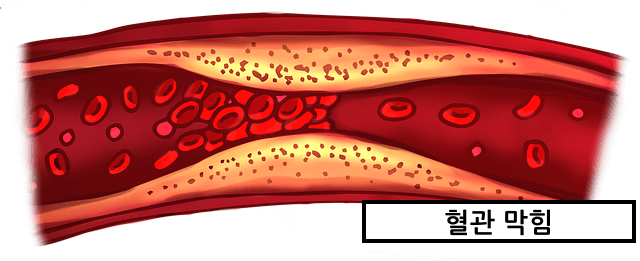 고지혈증혈관막힘