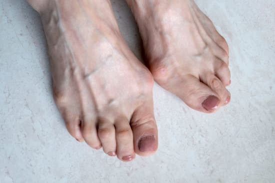 무지외반증 (Hallux Valgus) │ 엄지발가락이 휘는 이유와 치료법