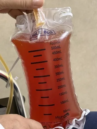 폐에 물이 차는 원인 증상 물참 관리 포인트에 대한 건강정보_8