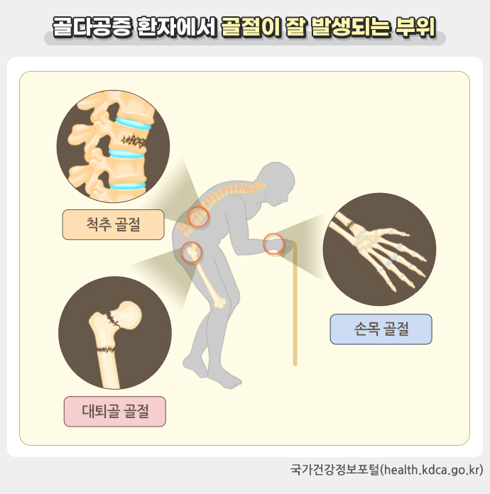 골다공증 증세,
