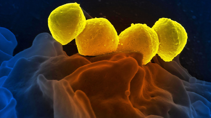 Bacterial infections, including streptococcus, staphylococcus, and tuberculosis 1