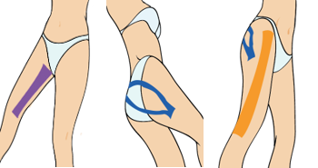 고관절통의 근육 테이핑 요법