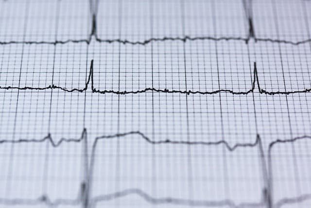심장의 전기적 활동을 보여주는 ECG 그래프