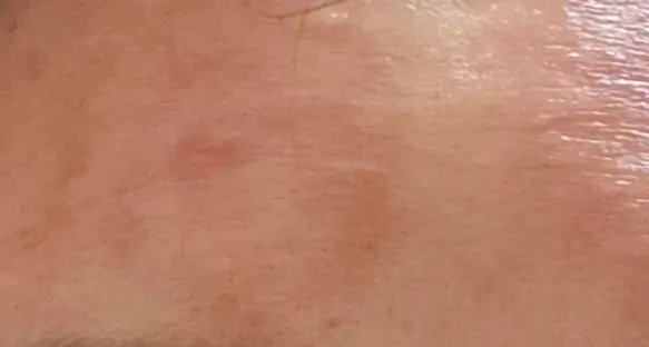 화장품 부작용의 증세