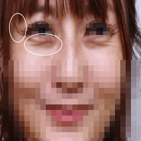 더모톡신 전 사진 예시