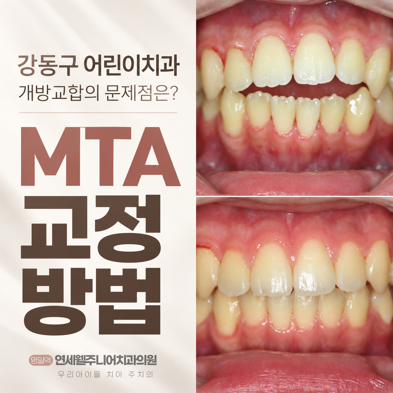 강동구 어린이치과 개방교합 MTA 교정 방법과 앞니 맞물림 개선 전후 비교 이미지