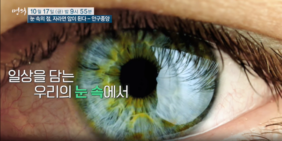 명의 눈속의 점 안구종양