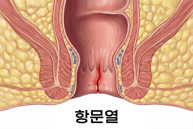 만성변비 합병증 항문열