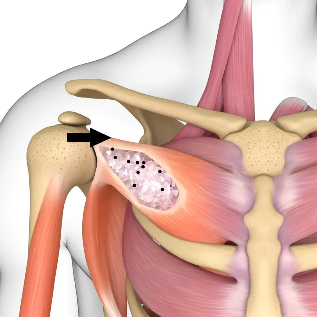 어깨 석회성건염이 생긴 이미지