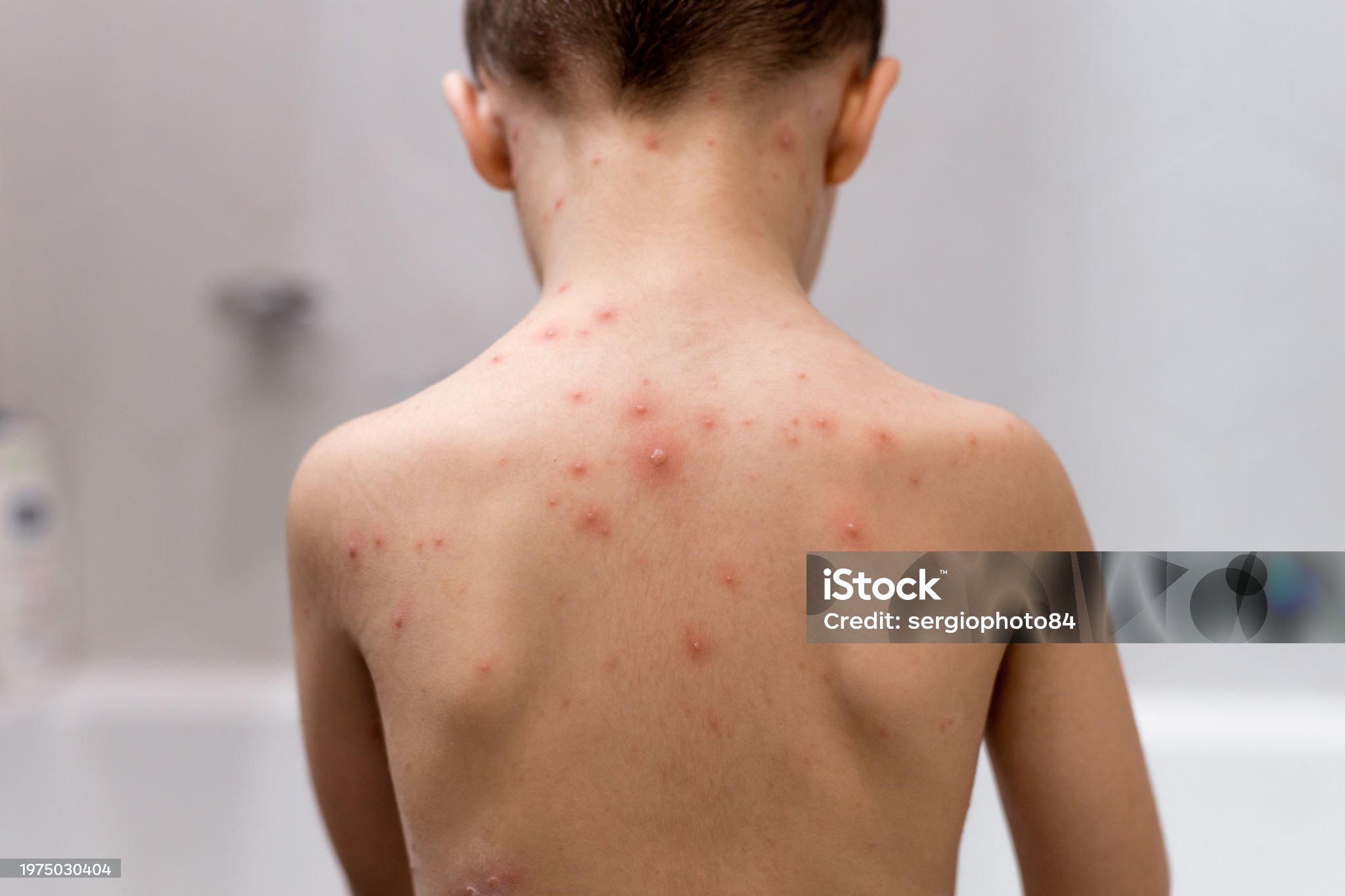 수두-관련-사진