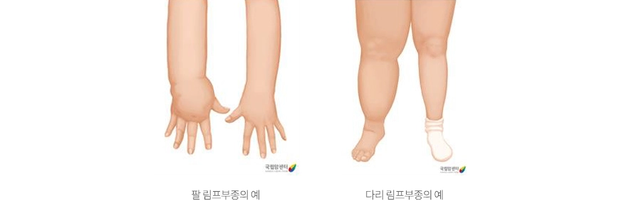 림프부종이란