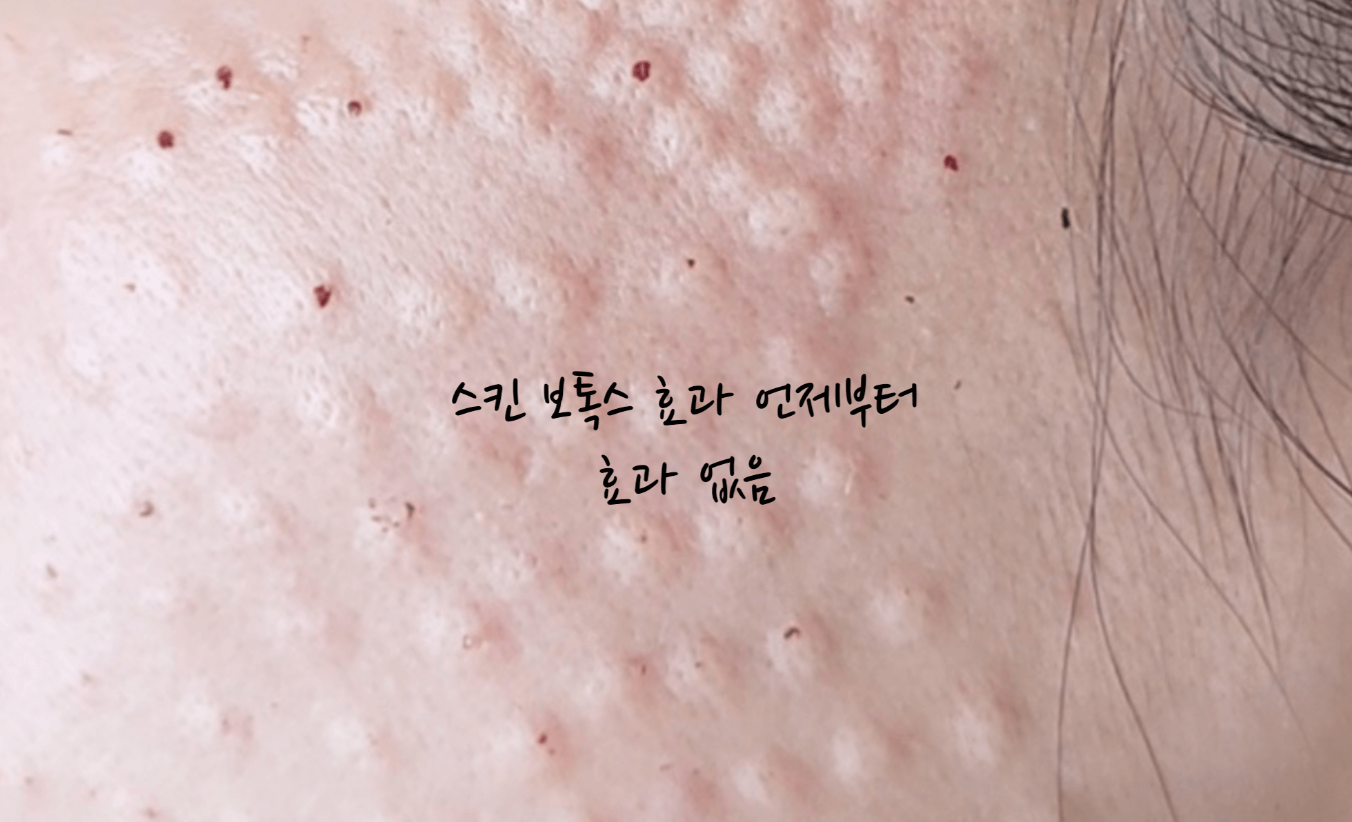 스킨 보톡스 효과