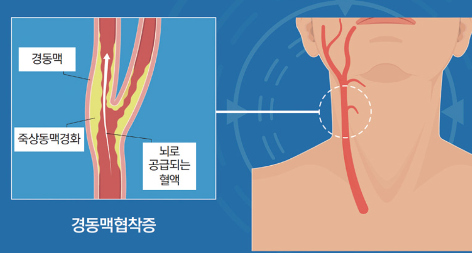 경동맥이 좁아져서 경화되는 협착증
