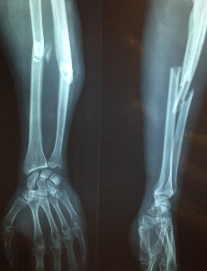 골절 엑스레이사진