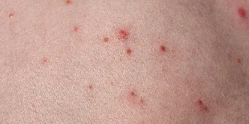 모낭염 증상&amp;#44; 원인&amp;#44; 치료 총 정리 (2025 최신)