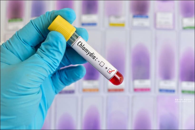 클라미디아 양성