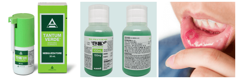탄툼 스프레이, 탄툼 가글, 구내염 사진