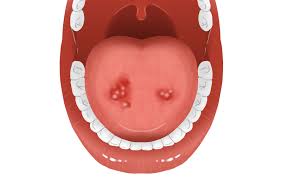 혓바늘 없애는 방법