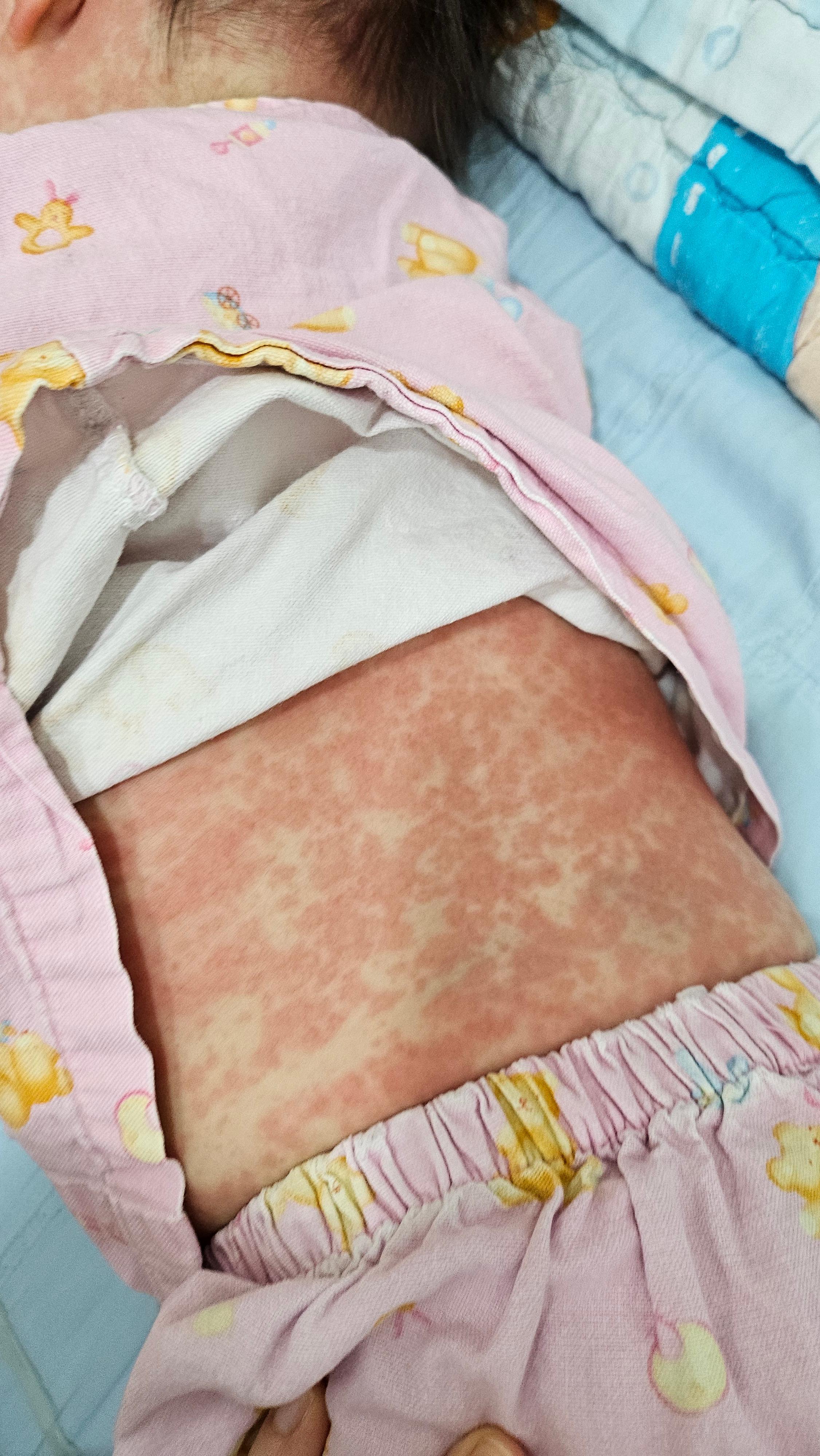 열꽃이 가장 심했을때 모습