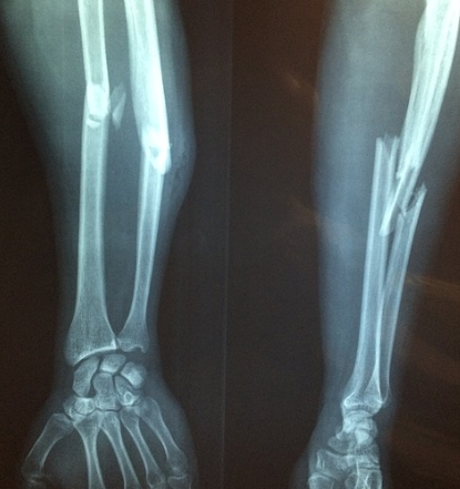 골다공증 원인과 증상