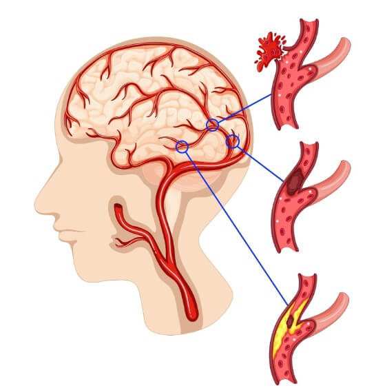 혈관 속 노폐물