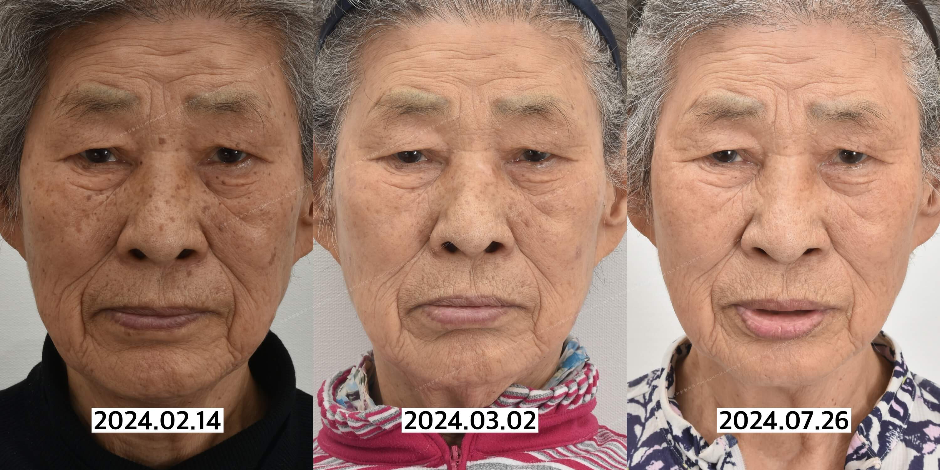 검버섯제거