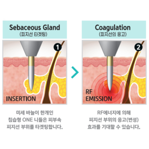 한관종 제거