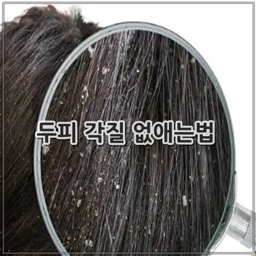 두피 각질 없애는법