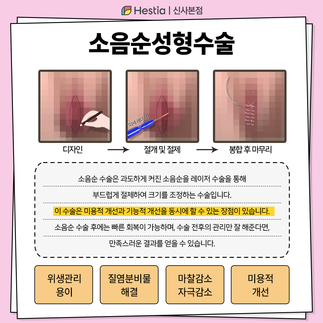 소음순수술이란?