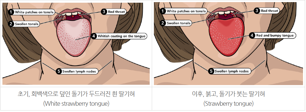 성홍열 발생 후 혀의 색깔 변화