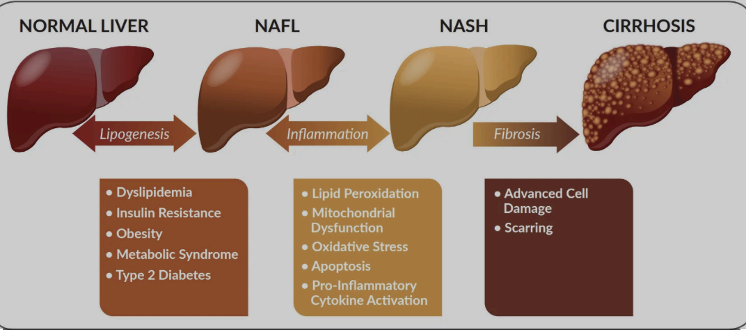 간경화증 (Liver cirrhosis)
